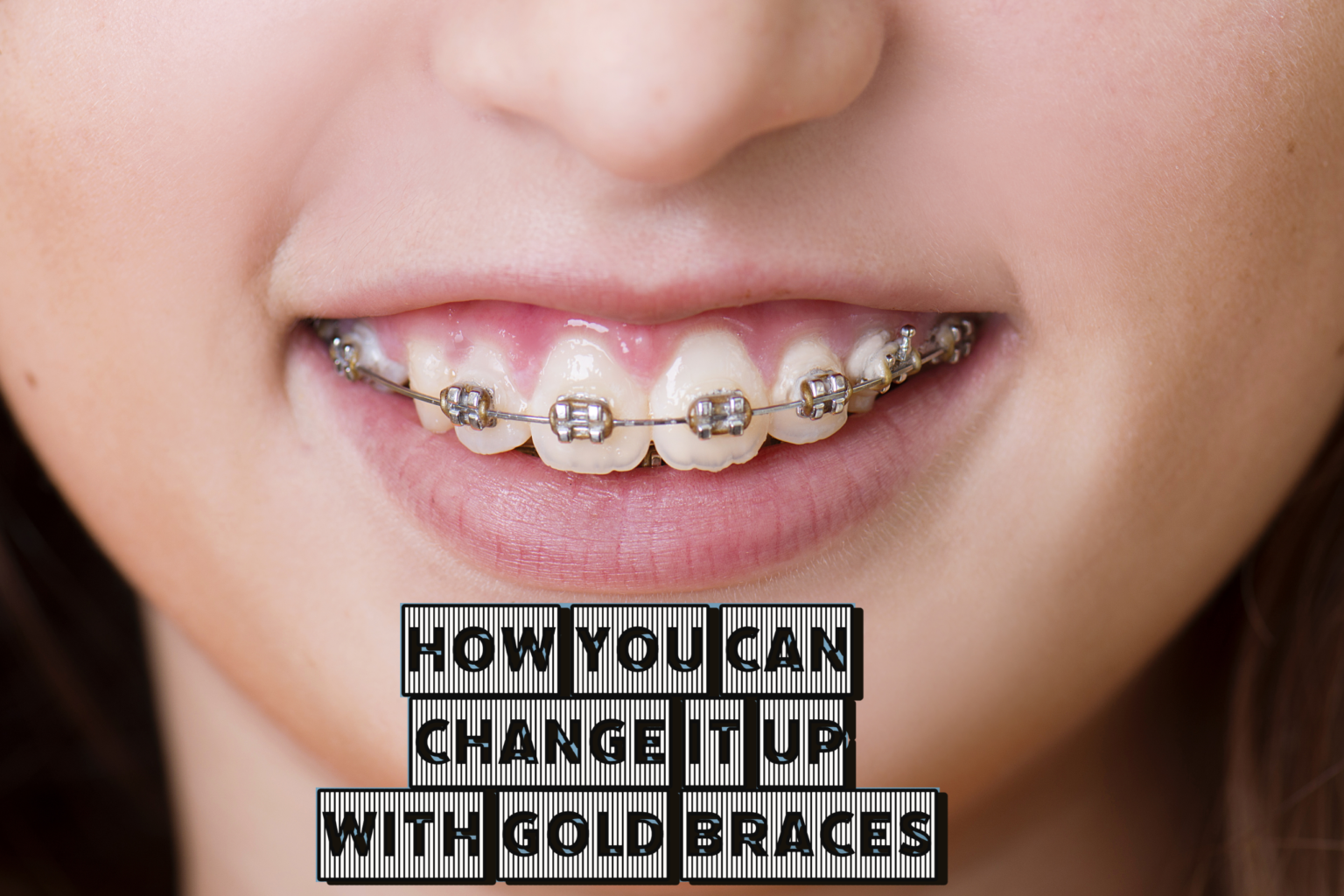 How You Can Change It Up With Gold Braces Lee Orthodontics